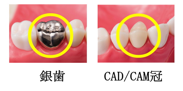 CAD/CAM（キャドカム）冠 | 巻田歯科医院